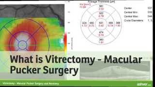 Vitrectomy  Macular Pucker Surgery and Recovery [upl. by Atiuqa]