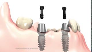 3 unit Bridge on implant abutments [upl. by Lannie]