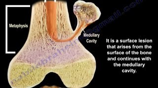 Osteochondroma  solitary and multiple  Everything You Need To Know  Dr Nabil Ebraheim [upl. by Jael74]