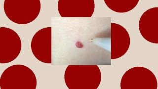 Cherry Angioma Removal [upl. by Ikila]