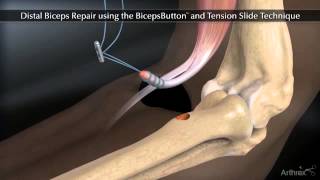 Arthrex Distal Biceps Button Tension Slide Technique [upl. by Towland]