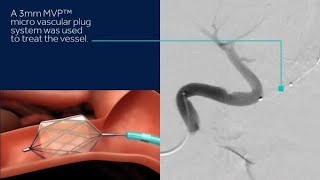 Pulmonary Arteriovenous Malformation Coil Embolization amp Plug Placement Lumsden MD Zubair MD [upl. by Nerraw]