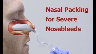 Nasal Packing for Severe Nosebleeds [upl. by Annayad]