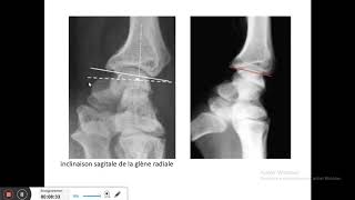 fractures de lextrémité nférieure du radius [upl. by Castera]