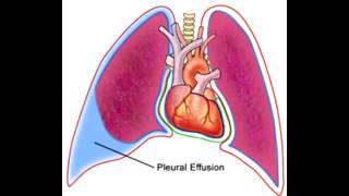 Pleural Effusions  Transudate Exudate amp Lymphatic [upl. by Rases]