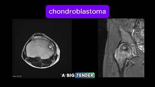 Chondroblastoma [upl. by Daphene125]