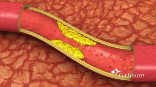 Heart Stents [upl. by Leonardi]