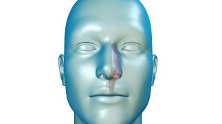 A Solution for Nasal Airway Obstruction [upl. by Norrej]