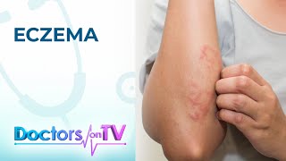 What is eczema  Patient Explainers [upl. by Nagap481]