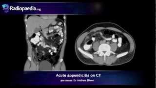 Appendicitis Diagnosis and Management – General Surgery  Lecturio [upl. by Eleazar495]