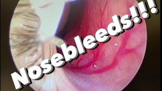 Nosebleeds epistaxis causes prevention treatments and more [upl. by Ringo]