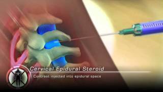 Cervical Epidural Steroid Injection Procedure Animation [upl. by Holle]