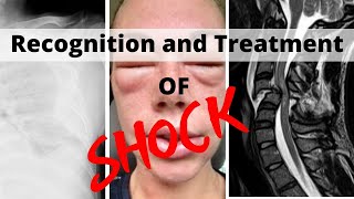 Recognition and Treatment of Shock [upl. by Aihc]