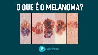 O que é melanoma 071 Dr Rogério Leite [upl. by Cirtemed]