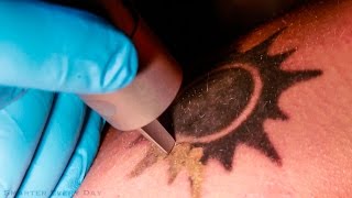 How Laser Tattoo Removal Works  Smarter Every Day 123 [upl. by Dixon967]