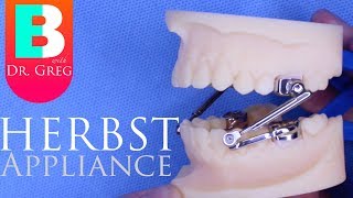 BRACES EXPLAINED Herbst Appliance [upl. by Anivram46]