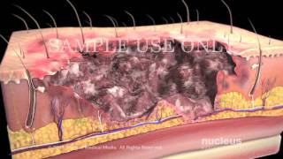 Burns Classification and Treatment [upl. by Airdnas]