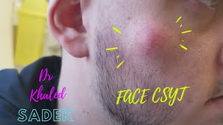 Large Face Cyst Removed Dr Khaled Sadek LipomaCystcom [upl. by Morrill]