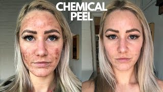 Chemical Peel On Sensitive Skin NEVER AGAIN [upl. by Aranaj861]