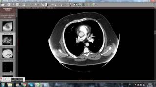 CT Computertomographie Lungenembolie Videoanalyse [upl. by Meekah803]