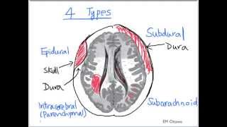 Intracranial Bleed  Part 1 [upl. by Malamud73]