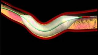 How long does a heart stent last [upl. by Nalyac20]