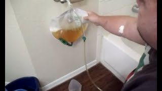 Kidney Failure After 20 Day Water Fast My Story [upl. by Yecak]