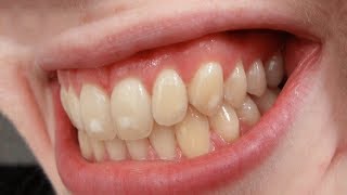 What is Dental Fluorosis  Dr Aniruddha KB [upl. by Ludovika]