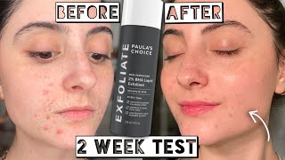 Testing Paula’s Choice 2 BHA LIQUID EXFOLIANT for Acne amp Scarring for 2 weeks [upl. by Theurer793]