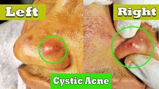 Drainage de lacné kystique sur le nez  cystic acne extraction [upl. by Hines780]