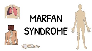 Marfan Syndrome  Diagnosis by Prof Julie De Backer [upl. by Edora]