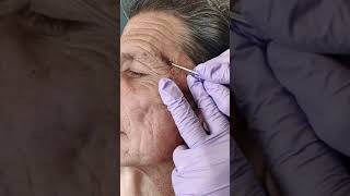 Acne extraction of blackheads and whiteheads popping pimples in Los Angeles [upl. by Chet837]