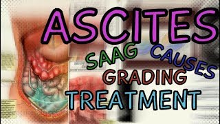 What are Ascites Transudate vs Exudate  SAAG  Fluid Wave Test  Shifting Dullness  Treatment [upl. by Kciregor285]