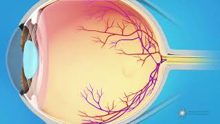 What causes a macular pucker [upl. by Guendolen545]