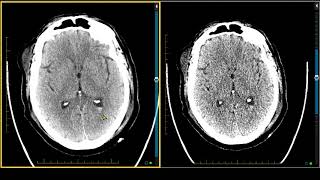 Brain Trauma — Intraventricular Hemorrhage on MRI [upl. by Aiuqcaj]