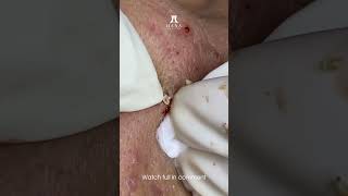 Big Cystic Acne Blackheads Extraction Blackheads amp Milia Whiteheads Removal Pimple Popping shorts [upl. by Johen]