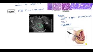 Endometrial Cancer and Hyperplasia for USMLE [upl. by Enilrac]