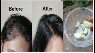 Grandmas SECRET Recipe for Hair growth in 30 days Garlic amp Coconut hair oil treatment [upl. by Silin]