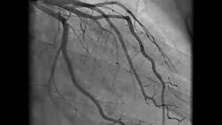 Coronary Angiography  NEJM [upl. by Rawna818]