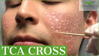 Acne Scar Removal with TCA Cross 80  Los Angeles  Dr Ben Behnam [upl. by Enilec]