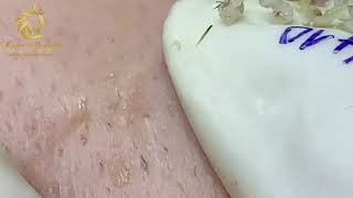 Blackheads and Whiteheads extraction 410  Loan Nguyen [upl. by Melda]