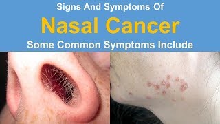 Signs And Symptoms Of Nasal Cancer [upl. by Liamaj]