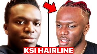 Hair Surgeon Reacts to KSI Hairline [upl. by Aicatsana]