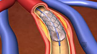 Heart stent can dissolve in patient [upl. by Lida700]