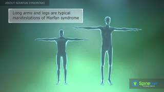 Marfan Syndrome About [upl. by Amaral688]