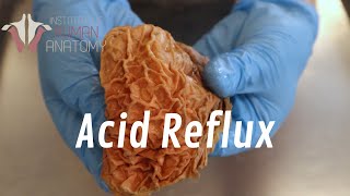 GERD Acid Reflux  Will Water Fasting Help [upl. by Aicilaanna]