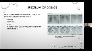 Pneumocystis jirovecii pneumonia  Current Issues in its Management [upl. by Euqinaj]