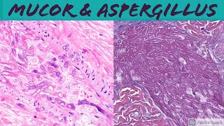 Mucormycosis amp Aspergillosis Angioinvasive Fungal Infection [upl. by Eimac]