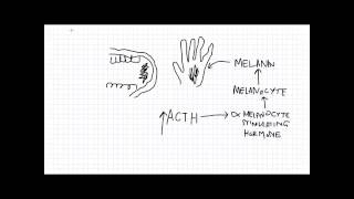 Adrenal Insufficiency [upl. by Halak]