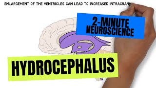 2Minute Neuroscience Hydrocephalus [upl. by Rabaj485]